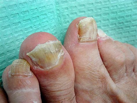 ugly feet pictures|nasty foot pics.